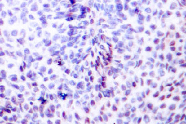 ATF2 Antibody - IHC of ATF2 (G56/39) pAb in paraffin-embedded human breast carcinoma tissue.