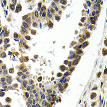 ATF2 Antibody - Immunohistochemistry of paraffin-embedded human breast cancer tissue.