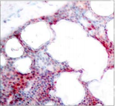 ATF2 Antibody - Detection of ATF2 (phospho-Ser62 or 44) in paraffin-embedded human breast carcinoma tissue.