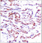 ATF2 Antibody - Detection of ATF2 (phospho-Thr71 or 53) in paraffin-embedded human breast carcinoma tissue.