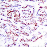 ATF2 Antibody - Detection of ATF2 (phospho-Ser112 or 94) in paraffin-embedded human breast carcinoma tissue.