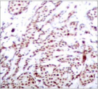 ATF2 Antibody - Detection of ATF2 (phospho-Thr73 or 55) in paraffin-embedded human breast carcinoma tissue.