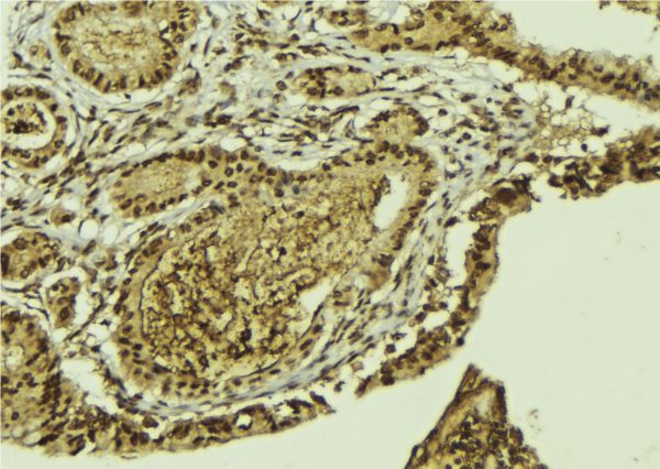 ATF2 Antibody - 1:100 staining mouse colon tissue by IHC-P. The sample was formaldehyde fixed and a heat mediated antigen retrieval step in citrate buffer was performed. The sample was then blocked and incubated with the antibody for 1.5 hours at 22°C. An HRP conjugated goat anti-rabbit antibody was used as the secondary.