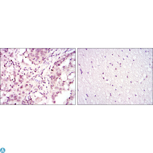 ATF2 Antibody - Immunohistochemistry (IHC) analysis of paraffin-embedded lung cancer (left) and brain tissues (right) with DAB staining using ATF-2 Monoclonal Antibody.