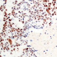 ATF2 Antibody - Immunohistochemical analysis of ATF2 (pT71) staining in human prostate cancer formalin fixed paraffin embedded tissue section. The section was pre-treated using heat mediated antigen retrieval with sodium citrate buffer (pH 6.0). The section was then incubated with the antibody at room temperature and detected using an HRP conjugated compact polymer system. DAB was used as the chromogen. The section was then counterstained with hematoxylin and mounted with DPX.