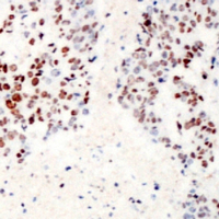 ATF2 Antibody - Immunohistochemical analysis of ATF2 (pS62) staining in human prostate cancer formalin fixed paraffin embedded tissue section. The section was pre-treated using heat mediated antigen retrieval with sodium citrate buffer (pH 6.0). The section was then incubated with the antibody at room temperature and detected using an HRP conjugated compact polymer system. DAB was used as the chromogen. The section was then counterstained with hematoxylin and mounted with DPX.