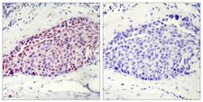 ATF2 Antibody - Peptide - + Immunohistochemical analysis of paraffin-embedded human breast carcinoma tissue using ATF-2 (Ab-112 or 94) antibody.