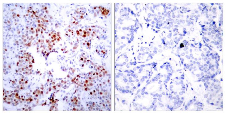 ATF2 Antibody - Peptide - + Immunohistochemical analysis of paraffin-embedded human breast carcinoma tissue using ATF-2 (Ab-62 or 44) antibody.