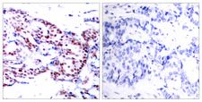 ATF2 Antibody - Immunohistochemical analysis of paraffin- embedded breast carcinoma. Left: Using ATF-2 (Ab-71or 53) Antibody; Right: The same antibody preincubated with synthesized peptide.