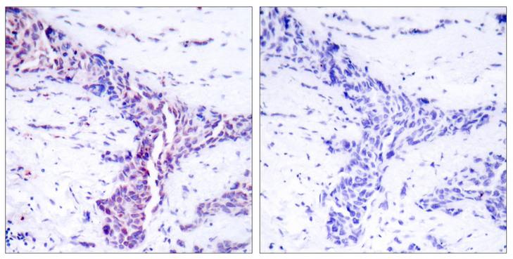 ATF2 Antibody - Peptide - + Immunohistochemical analysis of paraffin-embedded human breast carcinoma tissue using ATF-2 (Ab-73 or 55) antibody.
