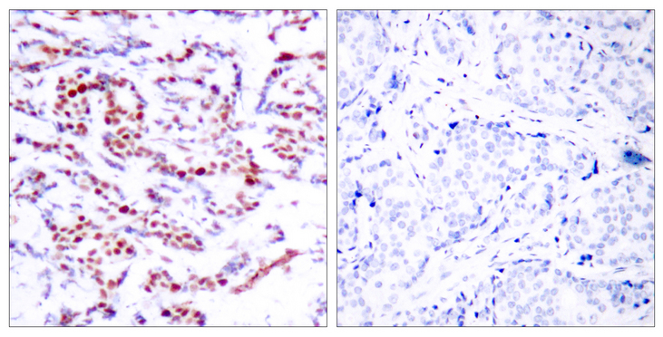ATF2 Antibody - Immunohistochemistry analysis of paraffin-embedded human breast carcinoma, using ATF2 (Phospho-Ser112 or 94) Antibody. The picture on the right is blocked with the phospho peptide.