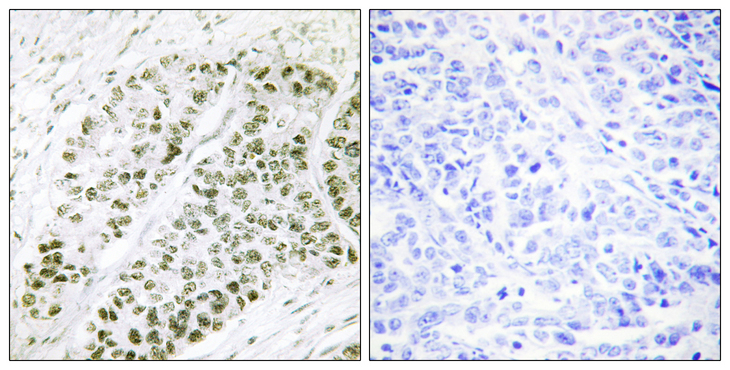 ATF2 Antibody - Immunohistochemistry analysis of paraffin-embedded human lung carcinoma, using ATF2 (Phospho-Ser480) Antibody. The picture on the right is blocked with the phospho peptide.