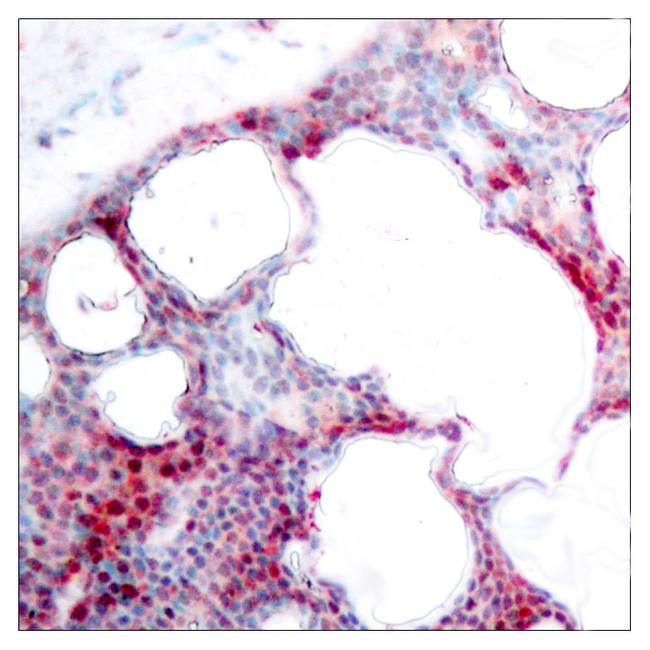 ATF2 Antibody - Immunohistochemical analysis of paraffin-embedded human breast carcinoma tissue using ATF-2 (phospho-Ser62 or 44) antibody.