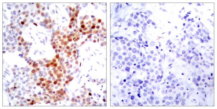 ATF2 Antibody - Immunohistochemical analysis of paraffin-embedded breast carcinoma. Left: Using ATF-2 (Phospho-Thr69 or 51) Antibody Antibody; Right: The same antibody preincubated with synthesized phospho-peptide.