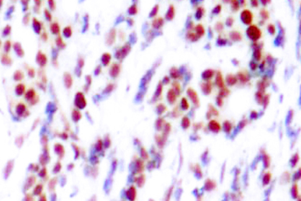 ATF2 Antibody - IHC of p-ATF2 (T71/53) pAb in paraffin-embedded human breast carcinoma tissue.