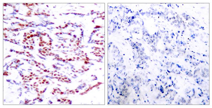 ATF2 Antibody - Immunohistochemical analysis of paraffin- embedded breast carcinoma. Left: Using ATF-2 (Phospho-Thr71 or 53) Antibody; Line2: The same antibody preincubated with synthesized phosphopeptide.