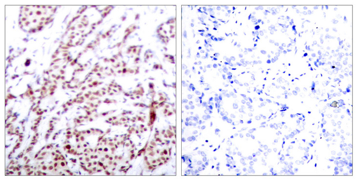 ATF2 Antibody - Immunohistochemistry analysis of paraffin-embedded human breast carcinoma, using ATF2 (Phospho-Thr73 or 55) Antibody. The picture on the right is blocked with the phospho peptide.