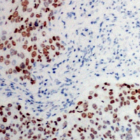 ATF2 Antibody - Immunohistochemical analysis of ATF2 (pT73) staining in human prostate cancer formalin fixed paraffin embedded tissue section. The section was pre-treated using heat mediated antigen retrieval with sodium citrate buffer (pH 6.0). The section was then incubated with the antibody at room temperature and detected using an HRP conjugated compact polymer system. DAB was used as the chromogen. The section was then counterstained with hematoxylin and mounted with DPX.