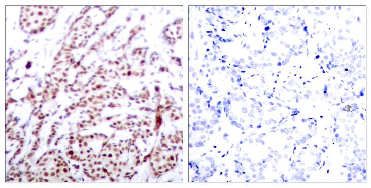 ATF2 Antibody - P-Peptide - + Immunohistochemical analysis of paraffin-embedded human breast carcinoma tissue, using ATF-2 (phospho-Thr73 or 55) antibody.