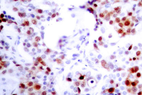 ATF2 Antibody - IHC of ATF2 (V63/45) pAb in paraffin-embedded human breast carcinoma tissue.