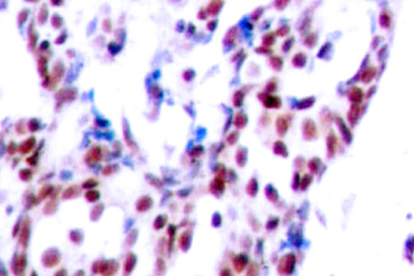 ATF2 Antibody - IHC of ATF2 (V65/47) pAb in paraffin-embedded human breast carcinoma tissue.