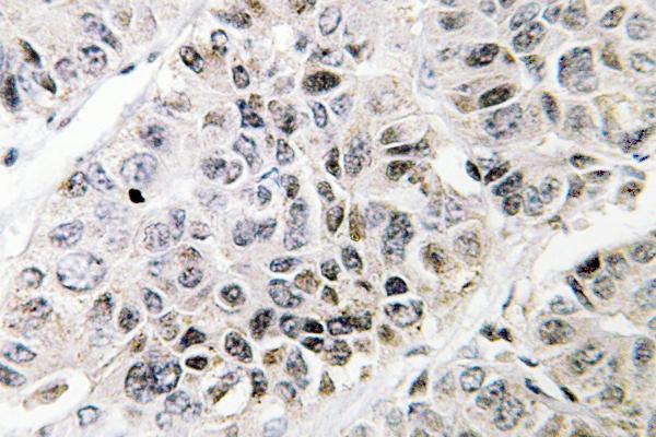 ATF3 Antibody - IHC of ATF-3 (N159) pAb in paraffin-embedded human lung carcinoma tissue.