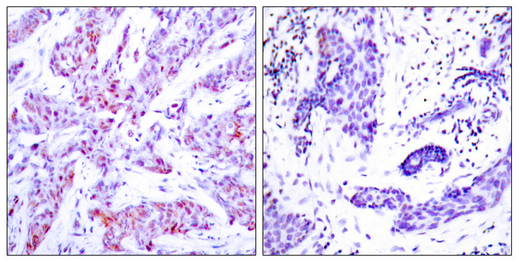 ATF4 Antibody - Immunohistochemistry analysis of paraffin-embedded human breast carcinoma, using ATF4 Antibody. The picture on the right is blocked with the synthesized peptide.