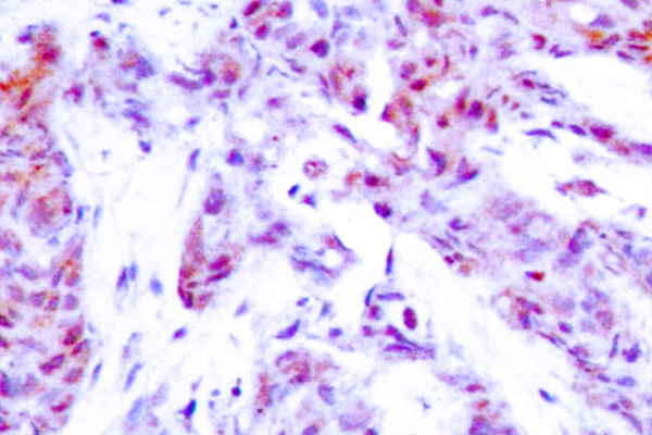 ATF4 Antibody - IHCanalysis of ATF4 (R239) pAb in paraffin-embedded human breast carcinoma tissue.