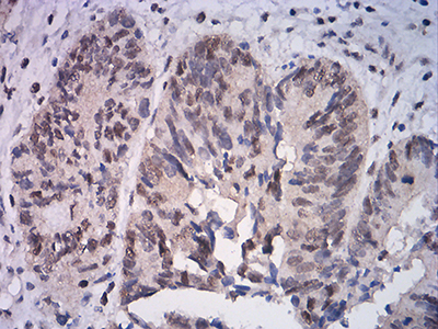 ATF4 Antibody - Immunohistochemical analysis of paraffin-embedded rectum cancer tissues using ATF4 mouse mAb with DAB staining.