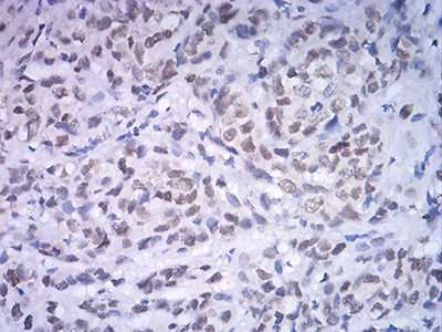 ATF4 Antibody - Immunohistochemical analysis of paraffin-embedded breast cancer tissues using ATF4 mouse mAb with DAB staining.