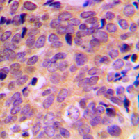 ATF4 Antibody - Immunohistochemical analysis of ATF4 staining in human breast cancer formalin fixed paraffin embedded tissue section. The section was pre-treated using heat mediated antigen retrieval with sodium citrate buffer (pH 6.0). The section was then incubated with the antibody at room temperature and detected using an HRP conjugated compact polymer system. DAB was used as the chromogen. The section was then counterstained with hematoxylin and mounted with DPX.
