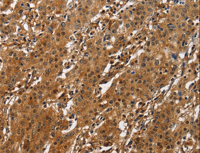 ATF4 Antibody - Immunohistochemistry of paraffin-embedded Human liver cancer using ATF4 Polyclonal Antibody at dilution of 1:50.