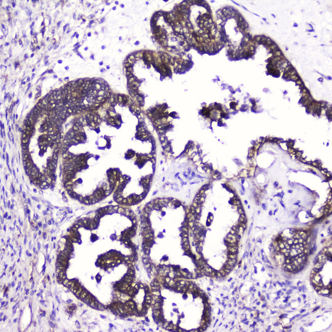 ATF4 Antibody - IHC analysis of ATF4 using anti-ATF4 antibody. ATF4 was detected in paraffin-embedded section of human ovary cancer tissue. Heat mediated antigen retrieval was performed in citrate buffer (pH6, epitope retrieval solution) for 20 mins. The tissue section was blocked with 10% goat serum. The tissue section was then incubated with 2?g/ml rabbit anti-ATF4 Antibody overnight at 4?C. Biotinylated goat anti-rabbit IgG was used as secondary antibody and incubated for 30 minutes at 37?C. The tissue section was developed using Strepavidin-Biotin-Complex (SABC) with DAB as the chromogen.