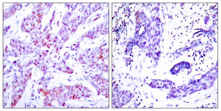 ATF4 Antibody - Immunohistochemical analysis of paraffin-embedded breast carcinoma, using ATF4 (Ab-245) Antibody. Left: Untreated; Right: Treated with synthesized peptide.