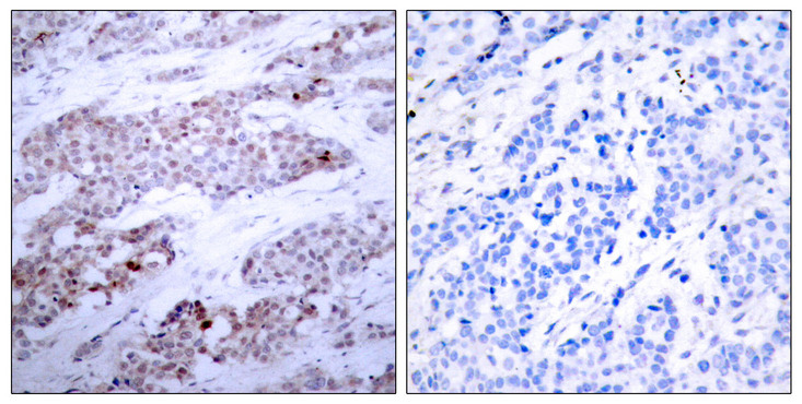 ATF4 Antibody - Immunohistochemistry analysis of paraffin-embedded human breast carcinoma, using ATF4 (Phospho-Ser245) Antibody. The picture on the right is blocked with the phospho peptide.