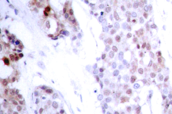 ATF4 Antibody - IHC of p-ATF4 (S245) pAb in paraffin-embedded human breast carcinoma tissue.