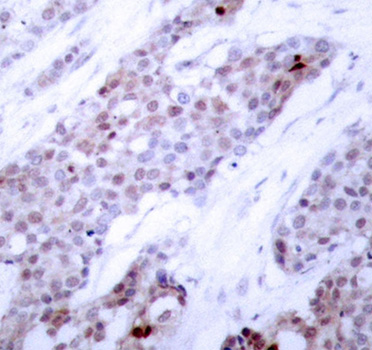 ATF4 Antibody - Immunohistochemical analysis of paraffin-embedded human breast carcinoma tissue.