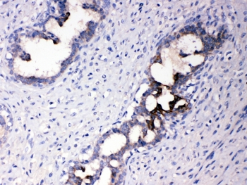 ATF6 Antibody - IHC testing of FFPE human breast cancer tissue with ATF6 antibody at 1ug/ml. Required HIER: steam section in pH6 citrate buffer for 20 min and allow to cool prior to testing.