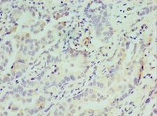 ATF7 Antibody - Immunohistochemistry of paraffin-embedded human lung cancer using antibody at 1:100 dilution.