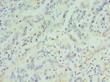ATF7 Antibody - Immunohistochemistry of paraffin-embedded human lung cancer tissue using antibody at 1:100 dilution.