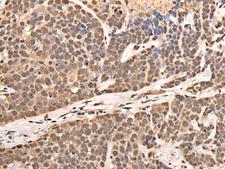 ATF7 Antibody - Immunohistochemistry of paraffin-embedded Human thyroid cancer tissue  using ATF7 Polyclonal Antibody at dilution of 1:40(×200)