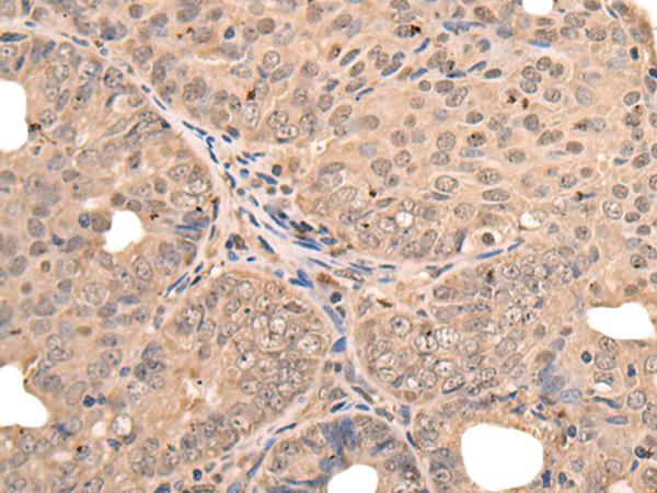 ATF7 Antibody - Immunohistochemistry of paraffin-embedded Human ovarian cancer tissue  using ATF7 Polyclonal Antibody at dilution of 1:40(×200)