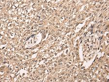 ATF7 Antibody - Immunohistochemistry of paraffin-embedded Human lung cancer tissue  using ATF7 Polyclonal Antibody at dilution of 1:40(×200)