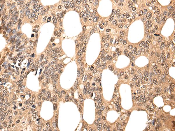 ATF7 Antibody - Immunohistochemistry of paraffin-embedded Human colorectal cancer tissue  using ATF7 Polyclonal Antibody at dilution of 1:40(×200)