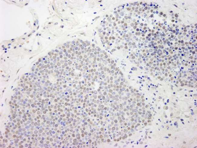 ATF7IP / MCAF1 Antibody - Detection of Human MCAF by Immunohistochemistry. Sample: FFPE section of human small cell lung cancer. Antibody: Affinity purified rabbit anti-MCAF used at a dilution of 1:250.