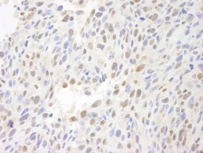 ATF7IP / MCAF1 Antibody - Detection of Mouse MCAF by Immunohistochemistry. Sample: FFPE section of mouse squamous cell carcinoma. Antibody: Affinity purified rabbit anti-MCAF used at a dilution of 1:250.