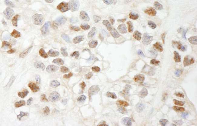 ATF7IP / MCAF1 Antibody - Detection of Human MCAF by Immunohistochemistry. Sample: FFPE section of human breast carcinoma. Antibody: Affinity purified rabbit anti-MCAF used at a dilution of 1:1000 (1 Detection: DAB.