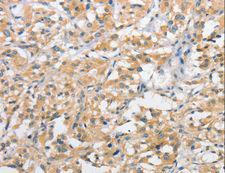 ATG10 Antibody - Immunohistochemistry of paraffin-embedded Human thyroid cancer using ATG10 Polyclonal Antibody at dilution of 1:60.