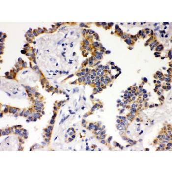 ATG14 Antibody - ATG14L antibody IHC-paraffin. IHC(P): Human Lung Cancer Tissue.