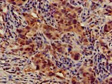 ATG14 Antibody - Immunohistochemistry of paraffin-embedded human pancreatic cancer using ATG14 Antibody at dilution of 1:100